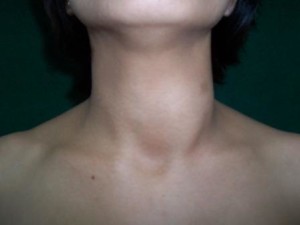 Thyroid4