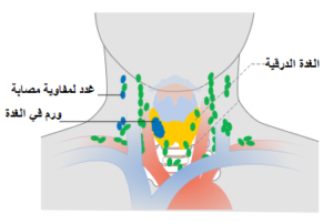 Thyroid CA