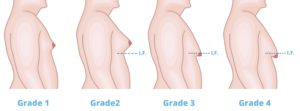 Gynecomastia grades